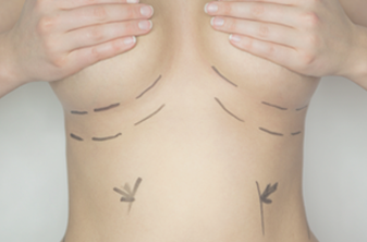 Augmentation mammaire par prothèses : quelle cicatrice ?