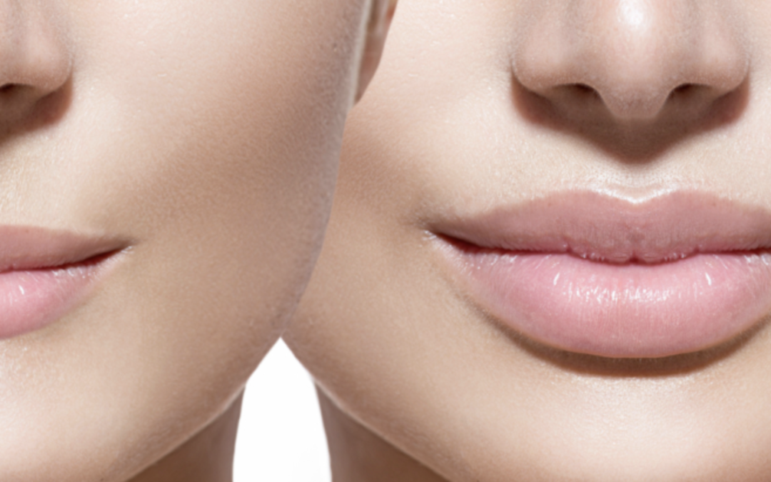 Augmentation des lèvres par acide hyaluronique : quelles sont les précautions à prendre ? Est-ce douloureux ?