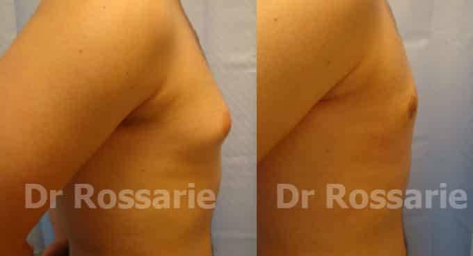 Gynécomastie : dans quels cas opérer la poitrine chez l'homme ...