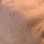 Cicatrices d'acné avant dermabrasion chirurgical