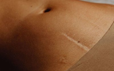 Chirurgie esthétique et cicatrisation : tout ce que vous devez savoir